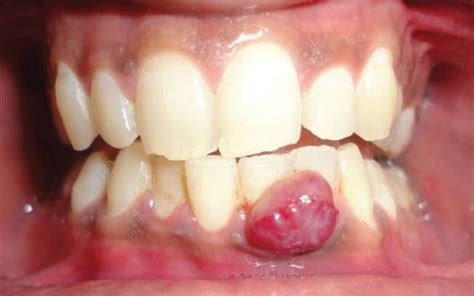 Pyogenic Granuloma During Pregnancy - MEDizzy