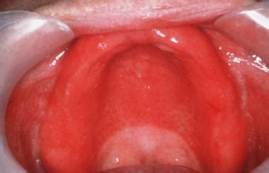 Mucosal Candidiasis Clinical Presentation: Physical Examination