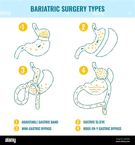 Bariatric surgery types, illustration Stock Photo - Alamy