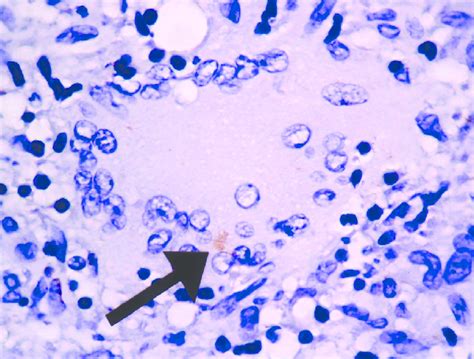 Mycobacterium Bovis