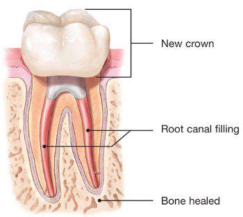 Root Canal Retreatment - Best Endodontics