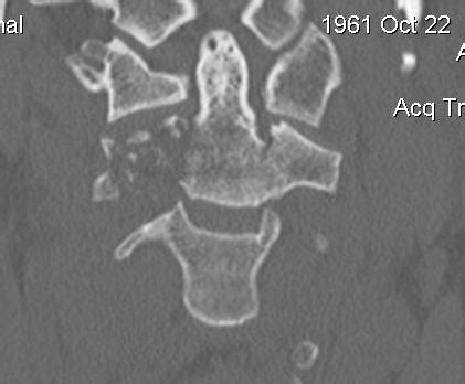 Dens Fracture | The Bone School