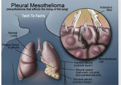 Copd Stages And Life Expectancy Stage 3