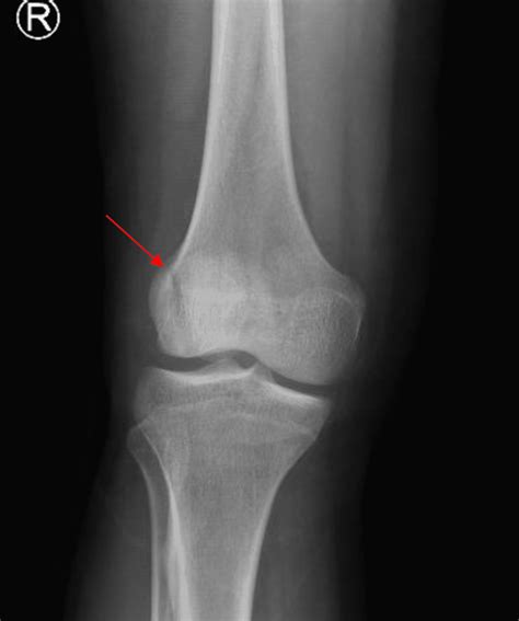 Cureus | Vertical Patella Fracture Fixed by Plate and Screws With Bone Graft: A Case Report