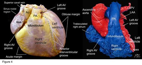 Sulcus Terminalis Heart Anatomy