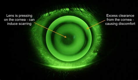 Scleral Lenses – EYETECH