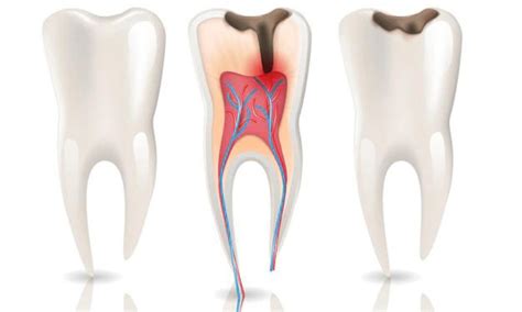 Understanding The Symptoms Of A Root Canal Infection