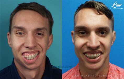 Jaw Surgery Before & After Photos - Law Plastic Surgery