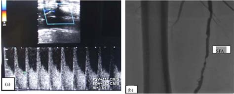 Significant stenosis in superficial femoral artery. (a) Increased peak ...