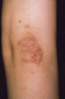 Erythema elevatum diutinum associated with Hashimoto's thyroiditis and antiphospholipid ...