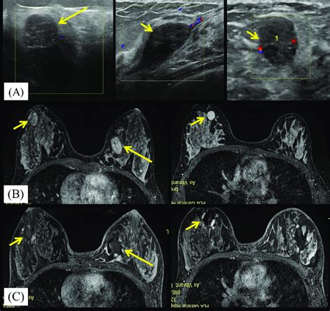 A 23-year-old woman with bilateral breast fibroadenomas. A. Ultrasound ...