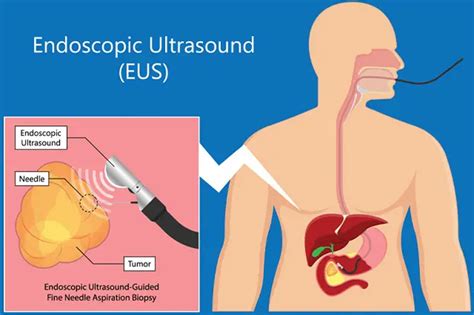 Endoscopic Ultrasound