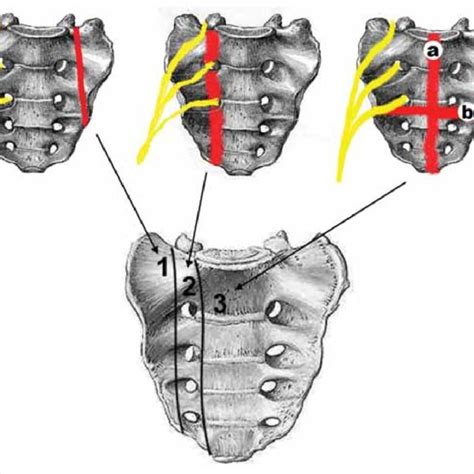 (PDF) Surgical Treatment in Sacral Fractures and Traumatic Spinopelvic Instabilities