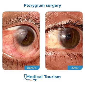 International Clinics For Pterygium | Medical Tourism Mexico