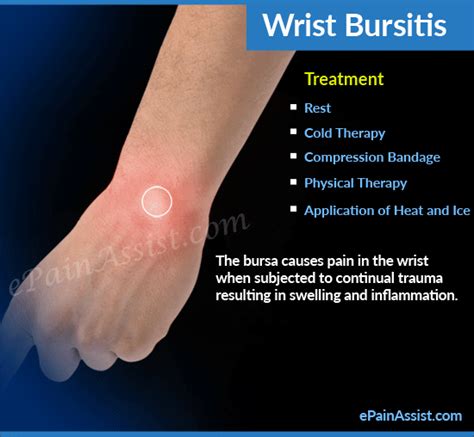 Wrist Bursitis GIFs - Find & Share on GIPHY