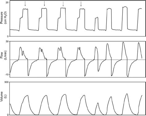 Ventilator breath stacking (arrows) occurs when a mandatory breath is... | Download Scientific ...