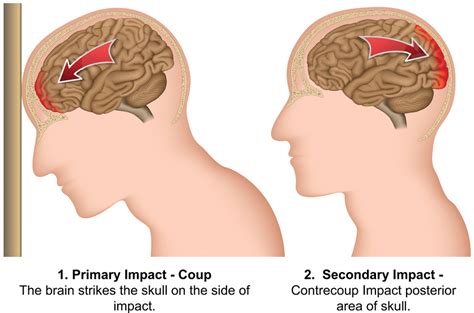 Coup Contrecoup Brain Injury - Charlie Waters Law