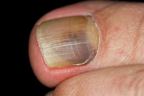 Fungal Infection Of The Toenail Photograph by Dr P. Marazzi/science Photo Library