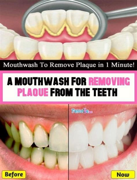 A mouthwash that removes the teeth plaque. in 2020 | Plaque teeth ...