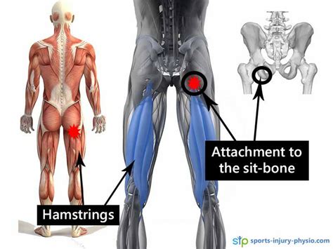 6 top tips for treating High Hamstring Tendinopathy | East Coast Physio