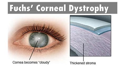 Femtosecond Laser-Assisted Cataract Surgery in Fuchs Endothelial Corneal Dystrophy: Long-term ...