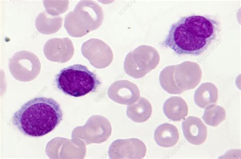 Hairy Cell Leukemia - Stock Image - M132/0965 - Science Photo Library