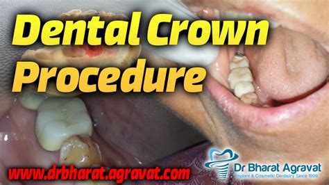 Dental Crown procedure cost for broken, Caries, after root canal ...