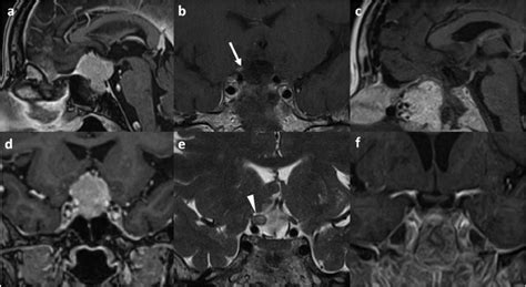 Tuberculum sellae meningioma WHO grade I (case 1). a, d... | Download ...