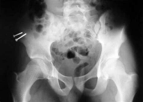 Avulsion fracture of the anterior superior iliac spine following apophysitis -- Pointinger et al ...