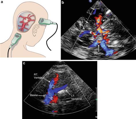 Essentials of Transcranial Doppler Ultrasound | Radiology Key