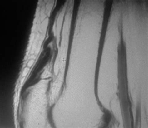 Quadriceps Tendon Tear-MRI - Sumer's Radiology Blog