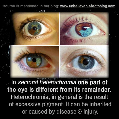 In sectoral heterochromia one part of the eye is different from it’s remainder. Heterochromia ...