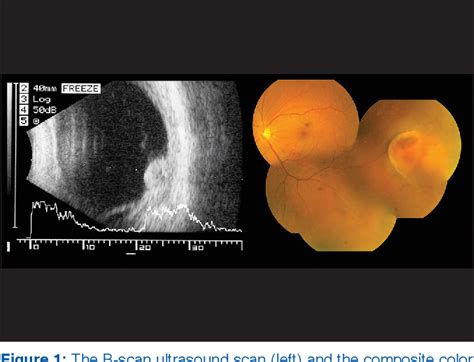 Figure 1 from A case of giant nodular posterior scleritis mimicking ...