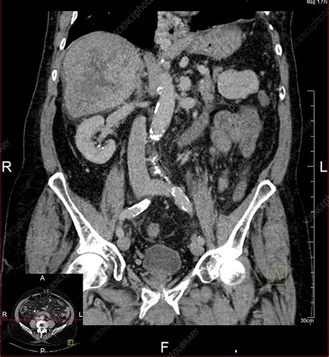 Liver cancer, CT scan - Stock Image - C019/9566 - Science Photo Library