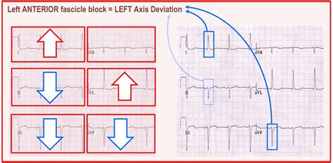 Left anterior fascicular block | Deranged Physiology