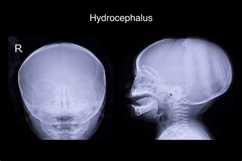 Hydrocephalus - Hart Garner, MD - Minnesota Spinal Neurosurgeon