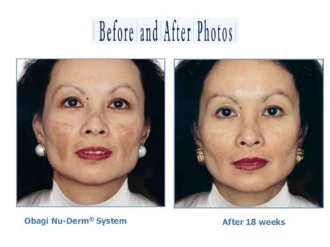 Obagi before and after photos