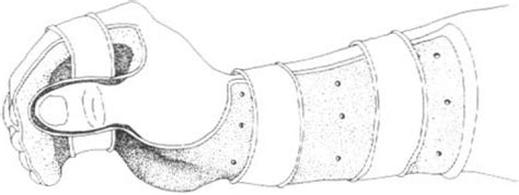 Resting pan or paddle splint (RPS) . | Download Scientific Diagram