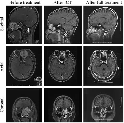 Frontiers | Multimodal Treatment With Orbital Organ Preservation in Adult Patients With Locally ...