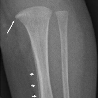 Series of radiographs indicates a classic metaphyseal fracture in an... | Download Scientific ...