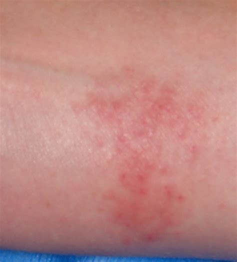 Management of Nickel Allergy - Dermatitis Academy