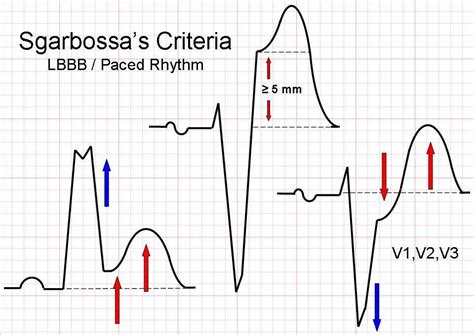 Sgarbossa Criteria