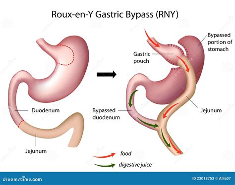 Roux-en-Y Gastric Bypass Surgery Stock Photos - Image: 23018753