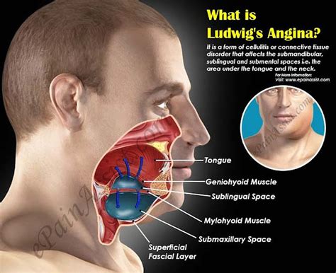 LUDWIG'S ANGINA: Symptoms, Causes, Treatment, Prognosis, Epidemiology ...