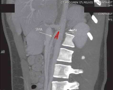 Mesenteric artery anatomy, function, branches & mesenteric artery ischemia