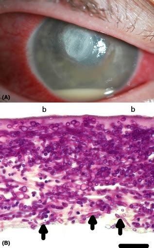 A) Slit-lamp photo of corneal fungal infiltrate in a 32-year-old male ...