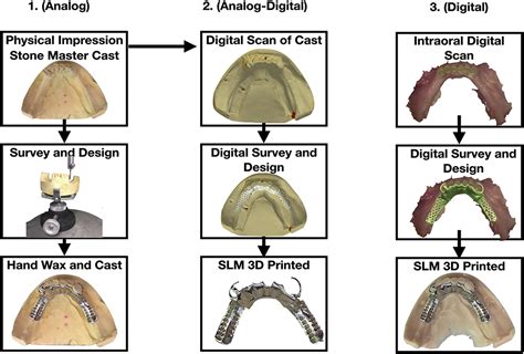 Components Of Removable Partial Denture - Design Talk