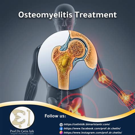 Treatment of osteomyelitis - Dr. What's wrong with you?