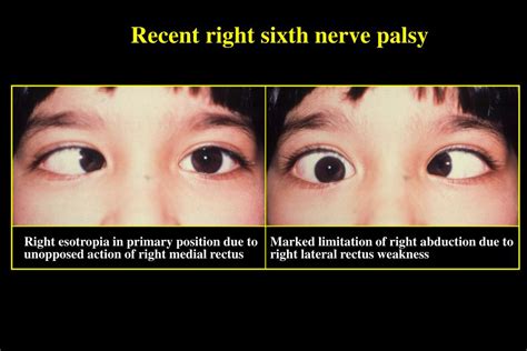 PPT - OCULAR MOTOR NERVE PALSIES PowerPoint Presentation, free download - ID:274793