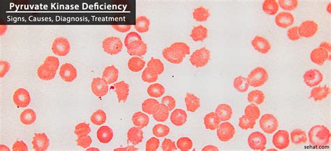 Pyruvate Kinase Deficiency Symptoms, Causes, Diagnosis, Treatment